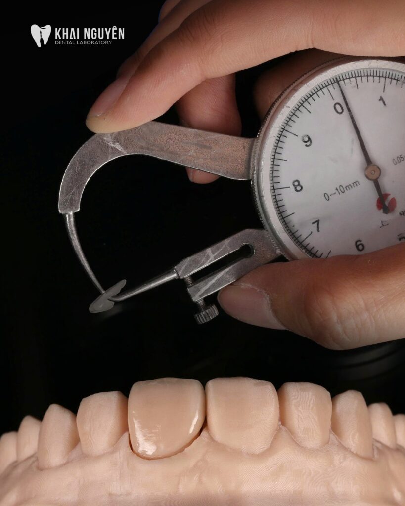 Ultra-thin 0.2 mm feldspathic veneer measured with a calliper, Khai Nguyen Dental Lab