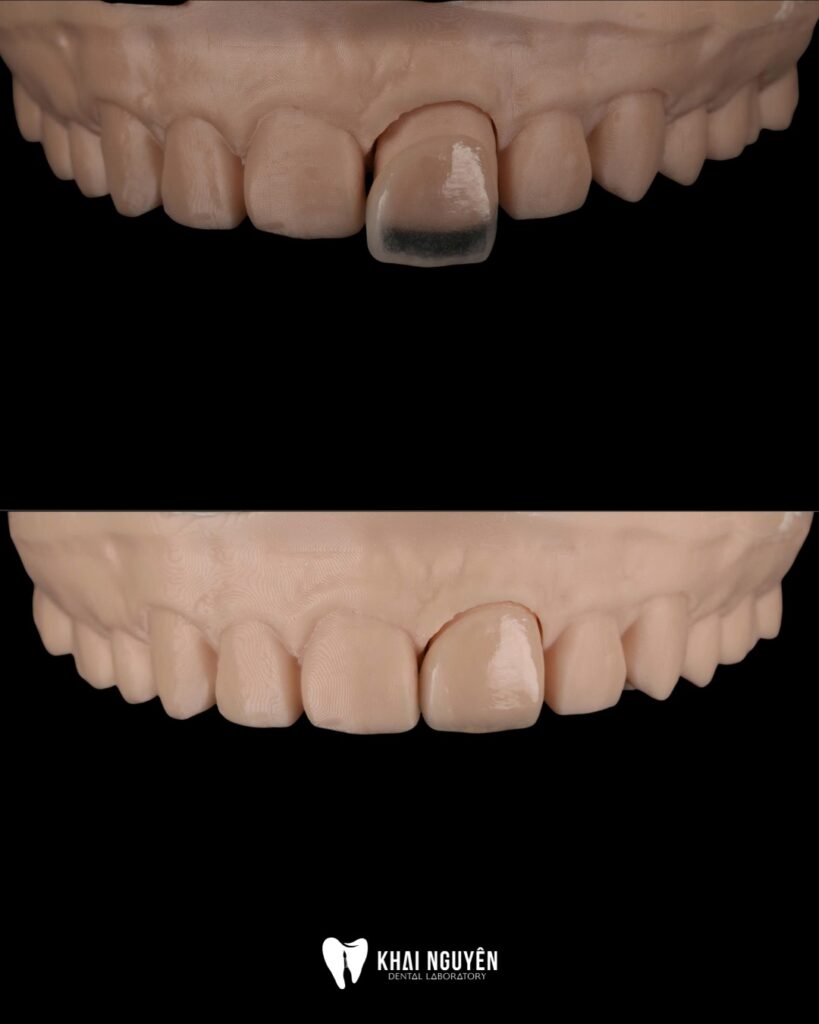 Feldspathic veneer for tooth 21 on the model, closing a diastema and lengthening the incisal edge to match tooth 11