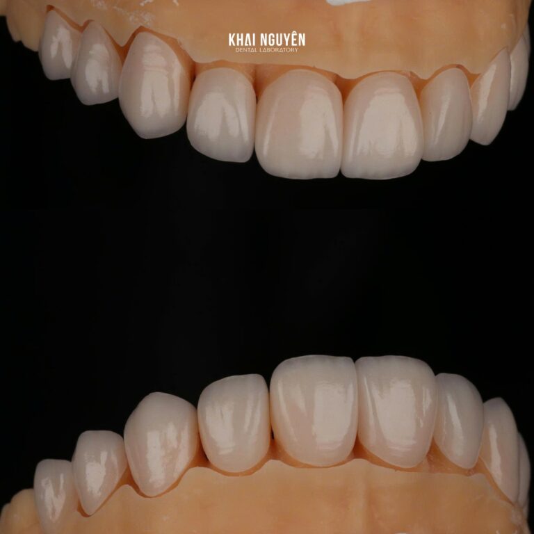 Ten feldspathic veneers seated on the model, frontal view