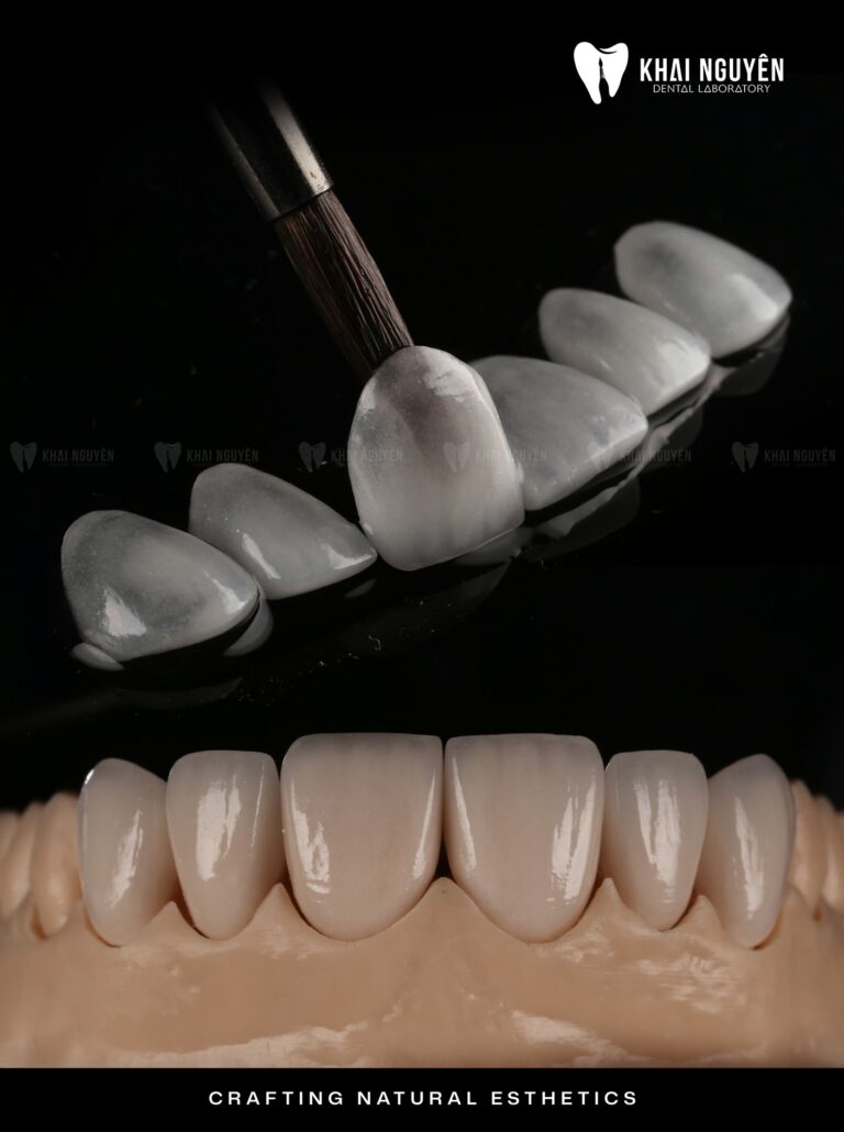 Six feldspathic veneers shade 1M1 on a glass plate and seated on the model, Khai Nguyen Dental Lab