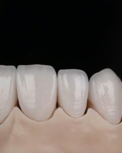 Close-up of hand-layered feldspathic veneers, enamel texture and translucency