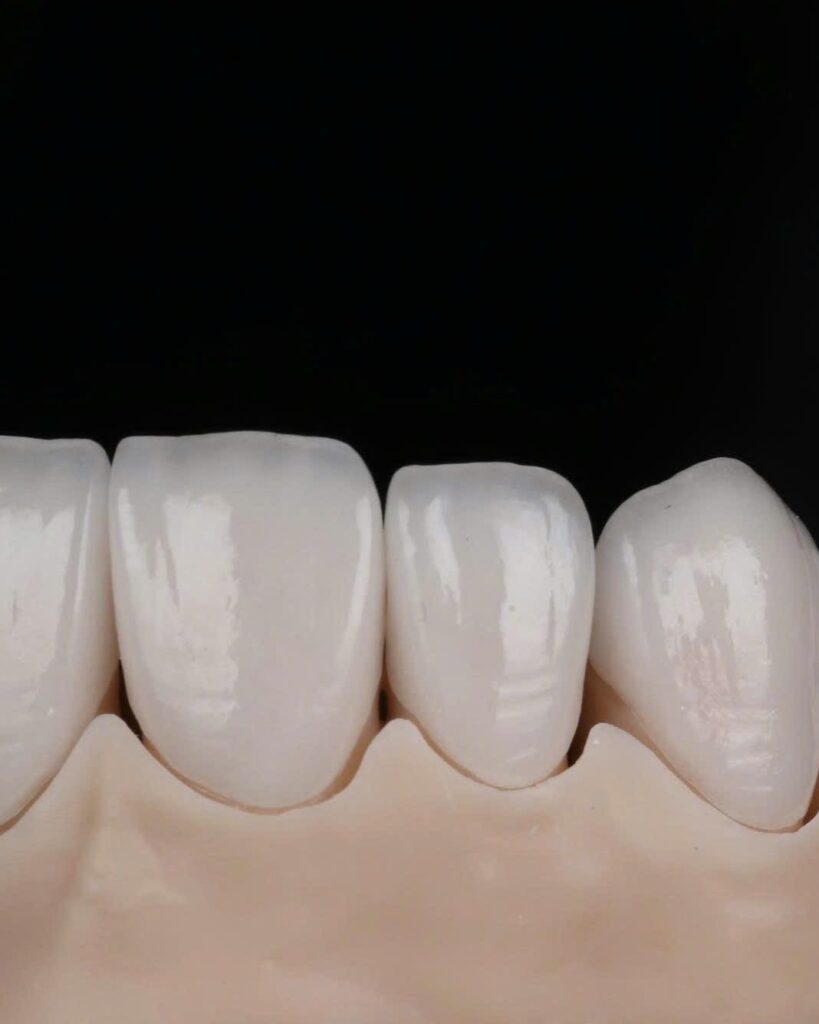 Close-up of hand-layered feldspathic veneers, enamel texture and translucency