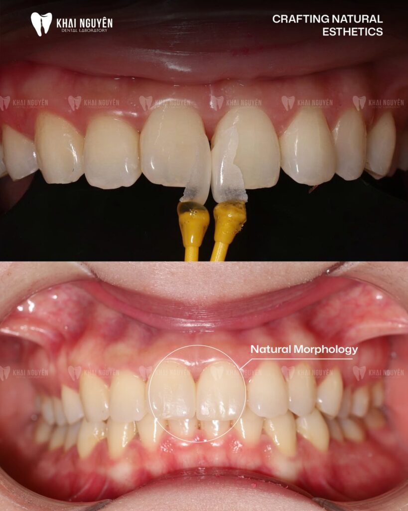 Two feldspathic veneers for diastema closure of the central incisors, before seating and after, Khai Nguyen Dental Lab