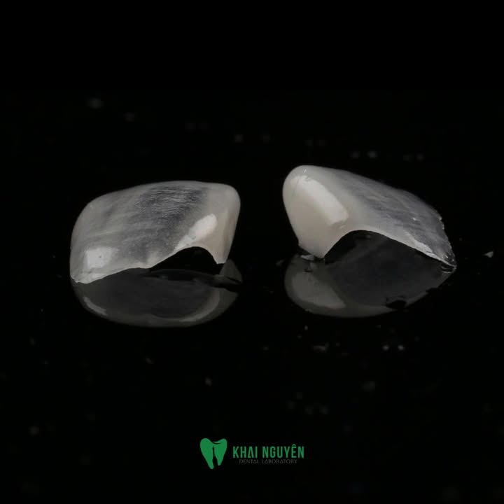 Veneer feldspathic đắp tay cho răng 11 và 21