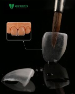 Veneer feldspathic đắp tay cho răng 11 và 21