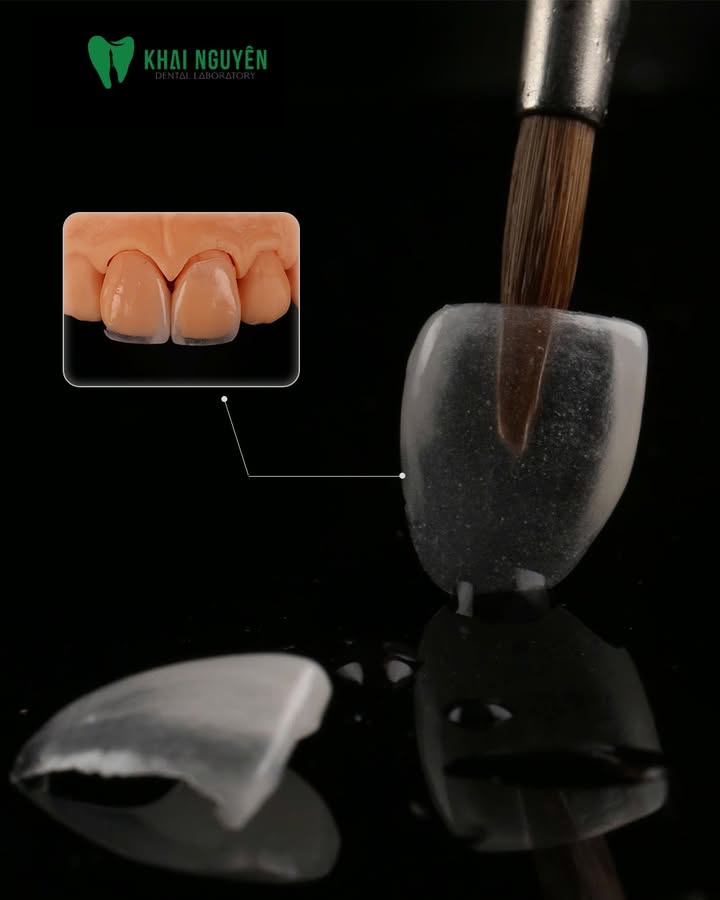 Veneer feldspathic đắp tay cho răng 11 và 21