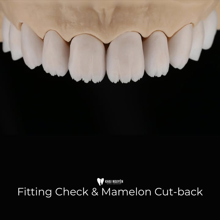 Veneer GC LiSi Press hoàn thiện tại Khai Nguyên Dental Lab