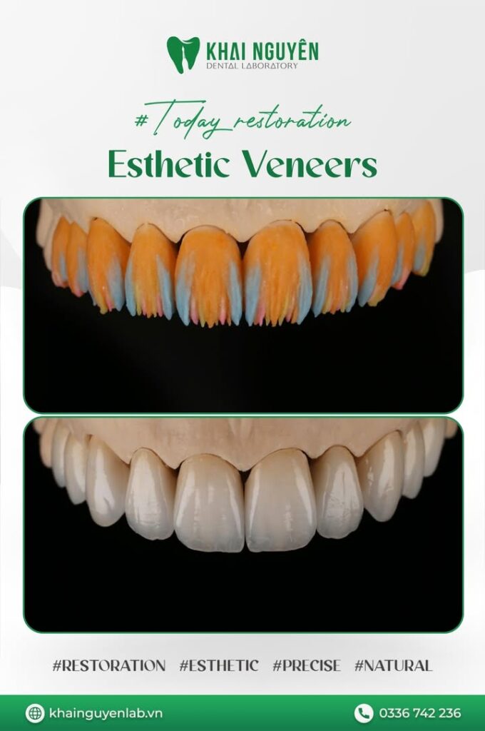 Veneer GC LiSi Press hoàn thiện tại Khai Nguyên Dental Lab