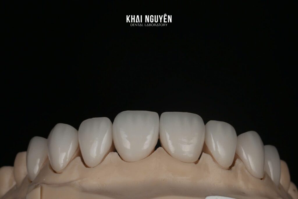 GC Initial LiSi Press veneers teeth 14 to 24, shade BL2, frontal view on the model