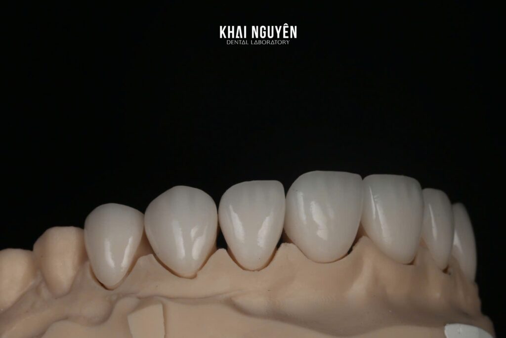 LiSi Press veneers 14 to 24 shade BL2, right lateral view