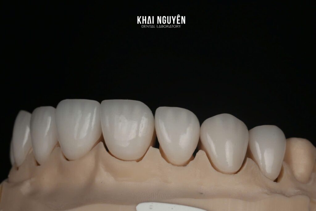 LiSi Press veneers 14 to 24 shade BL2, left lateral view