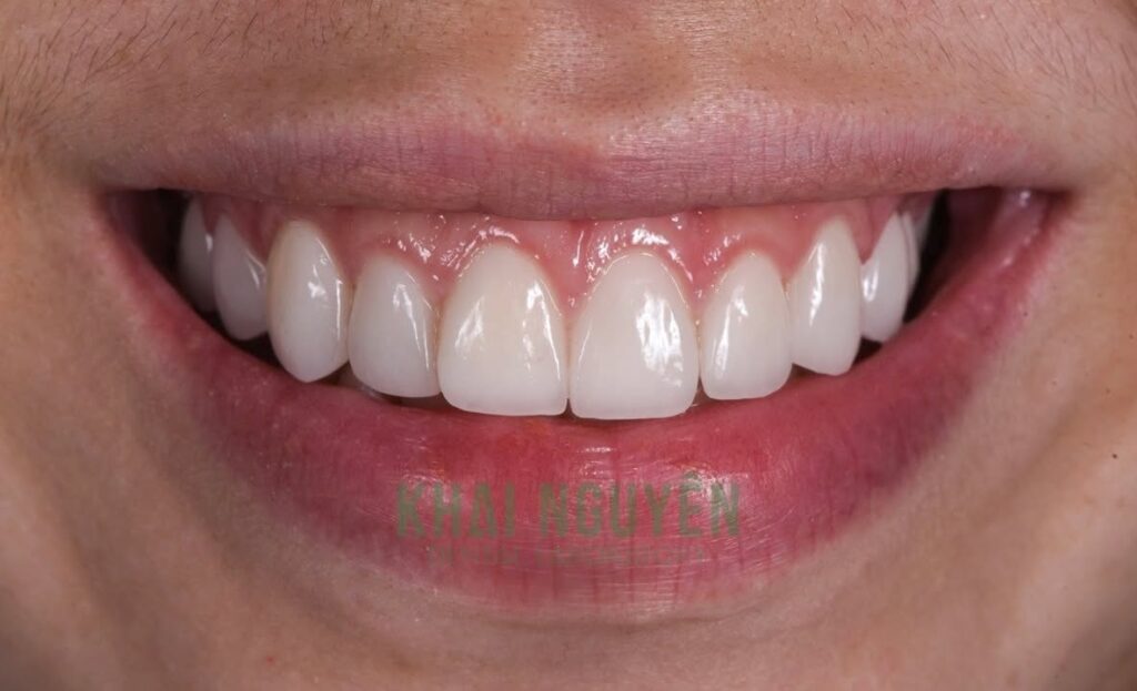 After: anterior veneers fitted, Khai Nguyen Dental Lab with Nhan Tam Dental