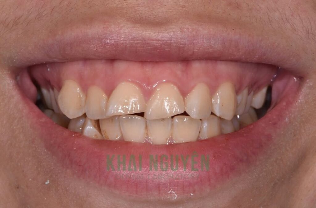 Before: worn and discoloured upper anterior teeth