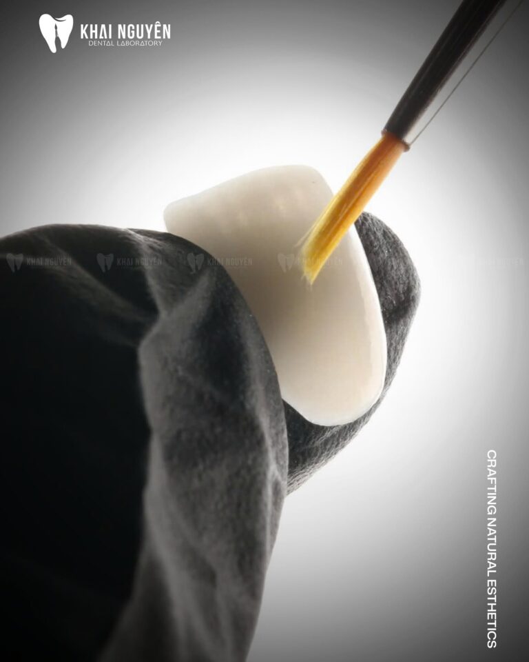 Single central incisor veneer held in a gloved hand during staining, Khai Nguyen Dental Lab