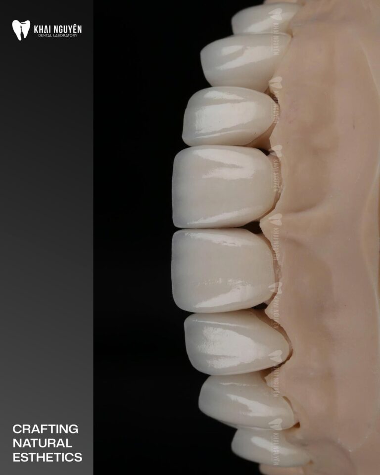 Porcelain veneers handcrafted at Khai Nguyen Dental Lab, Instagram 3 September 2026