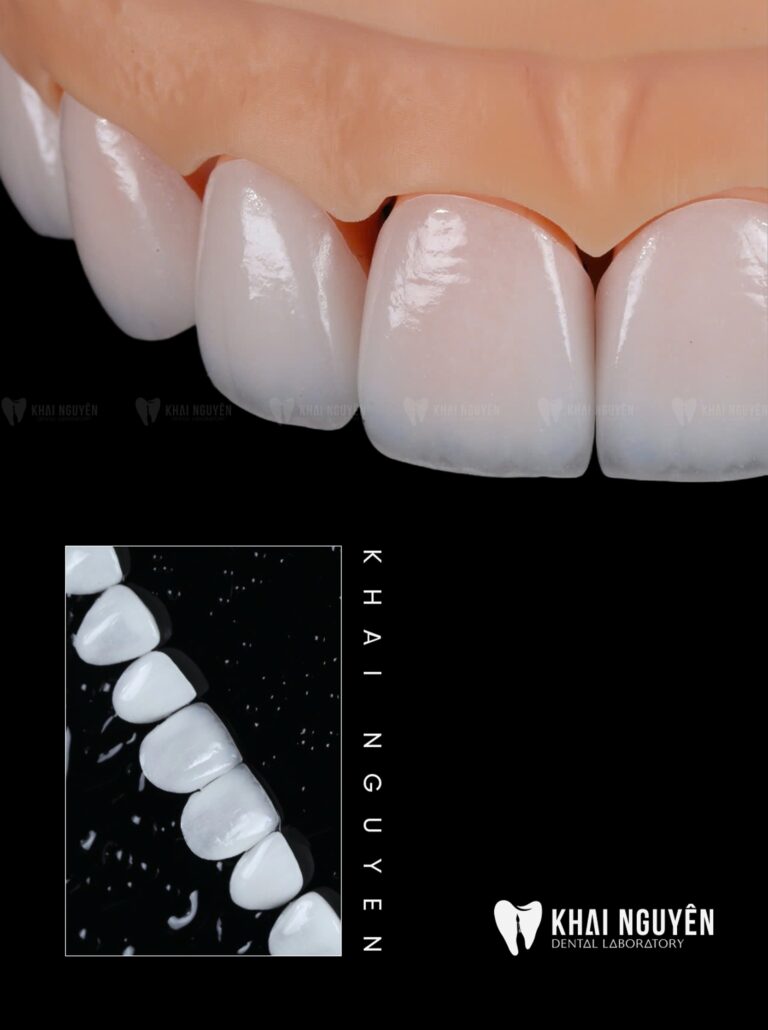 Natural-looking porcelain veneers on the model, Khai Nguyen Dental Lab, Instagram 26 August 2026