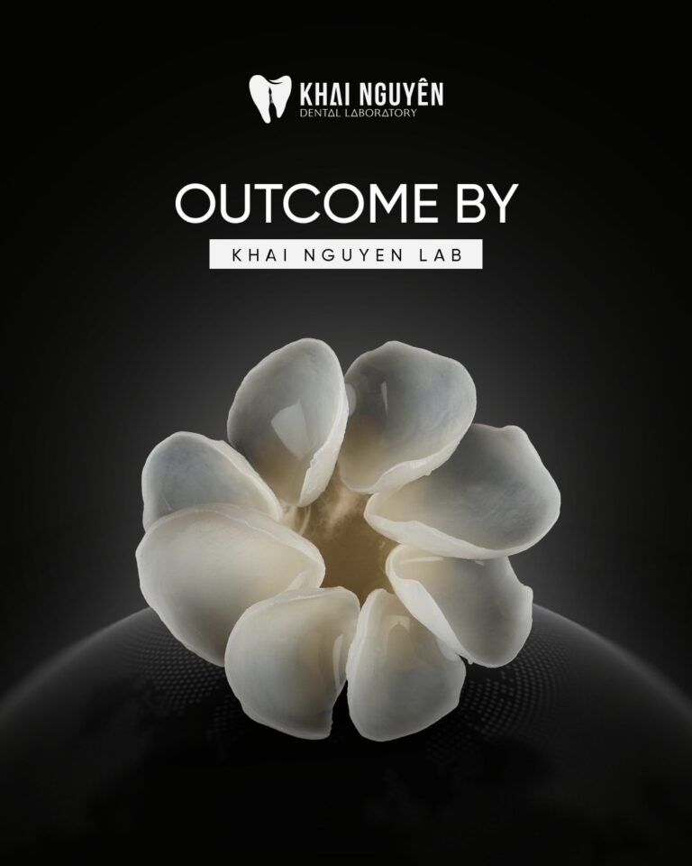 Finished porcelain veneers arranged in a circle, Khai Nguyen Dental Lab