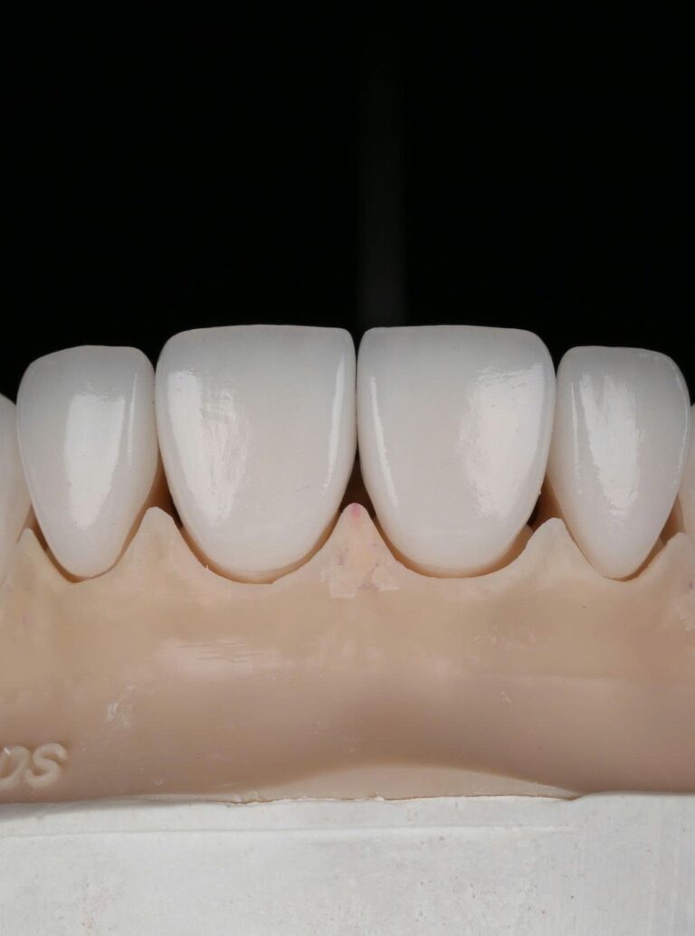 High-esthetic veneer case, close-up of enamel-like translucency