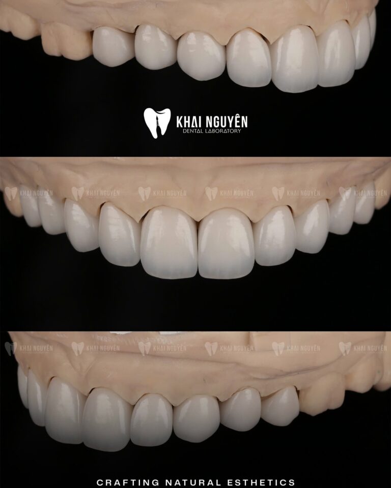 Anterior veneers and pressed crowns with natural translucency, three views on the model, Khai Nguyen Dental Lab