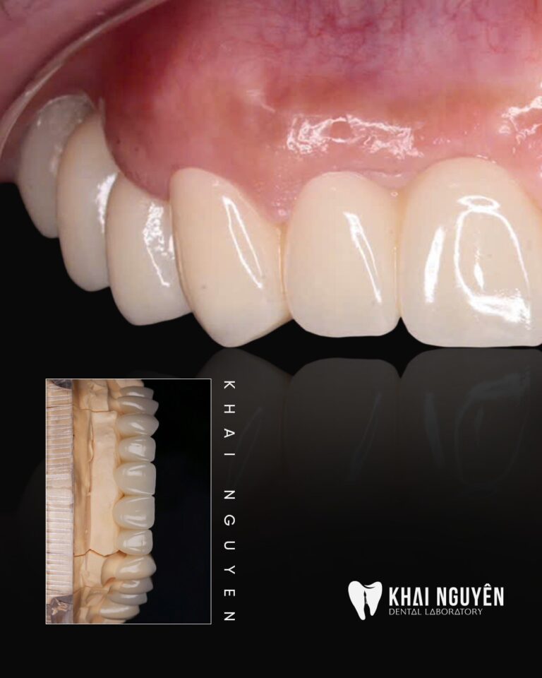 Full multilayer zirconia restoration, intraoral view after seating