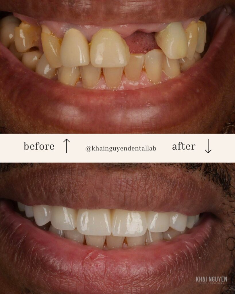 Before and after: full zirconia restoration for an international patient with bruxism and V-shaped wear, squared form and translucent incisal edges