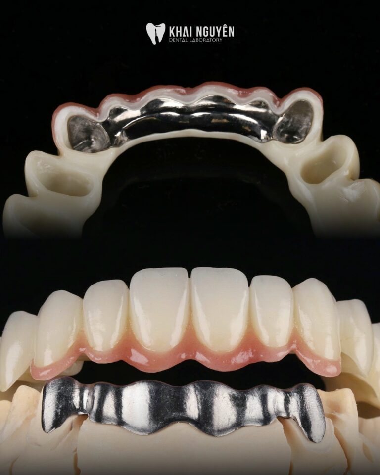 Zirconia on I-bar for a long-span implant restoration, frontal view