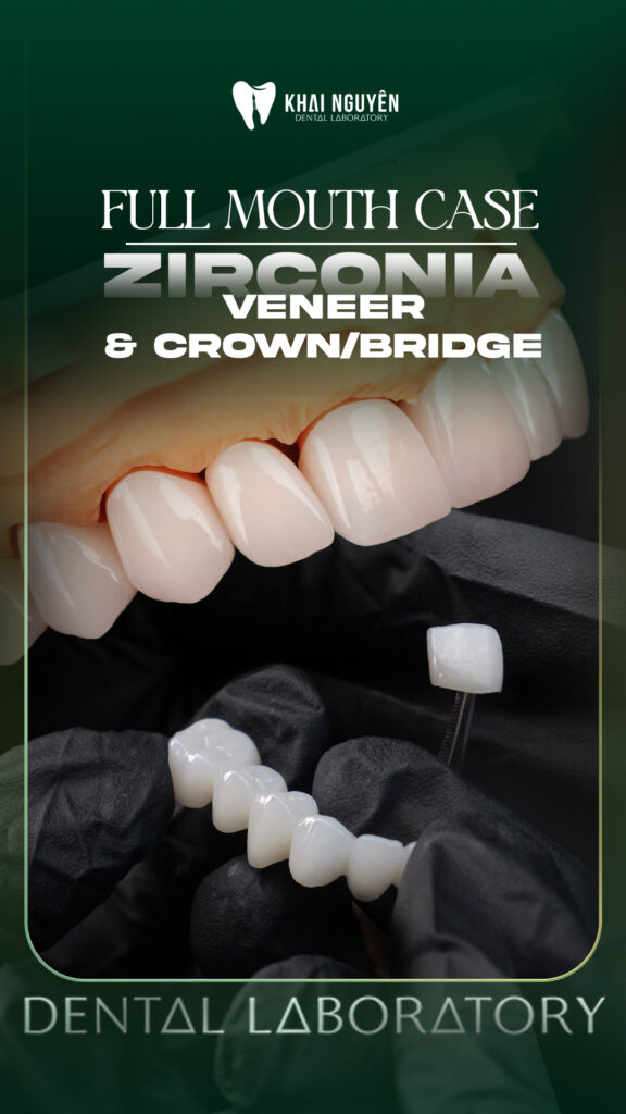 Phục hình toàn hàm bằng zirconia cho cả mão, cầu và veneer để che màu cùi và đồng bộ màu