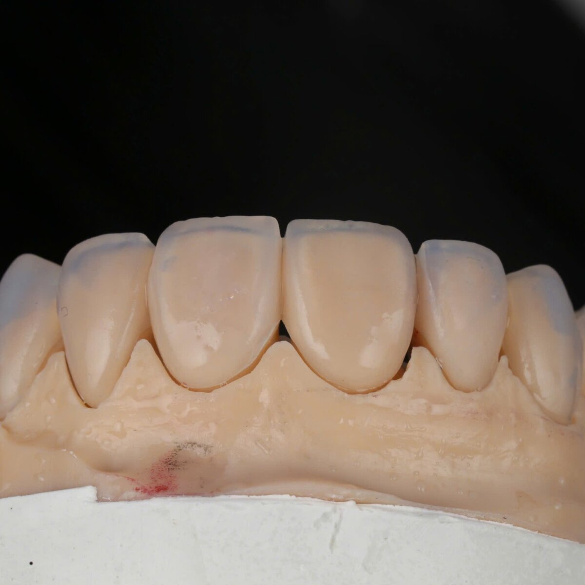 Ten Amber Mill veneers in 1M1–1M2 seated on the model, frontal view, made by Khai Nguyen Dental Lab
