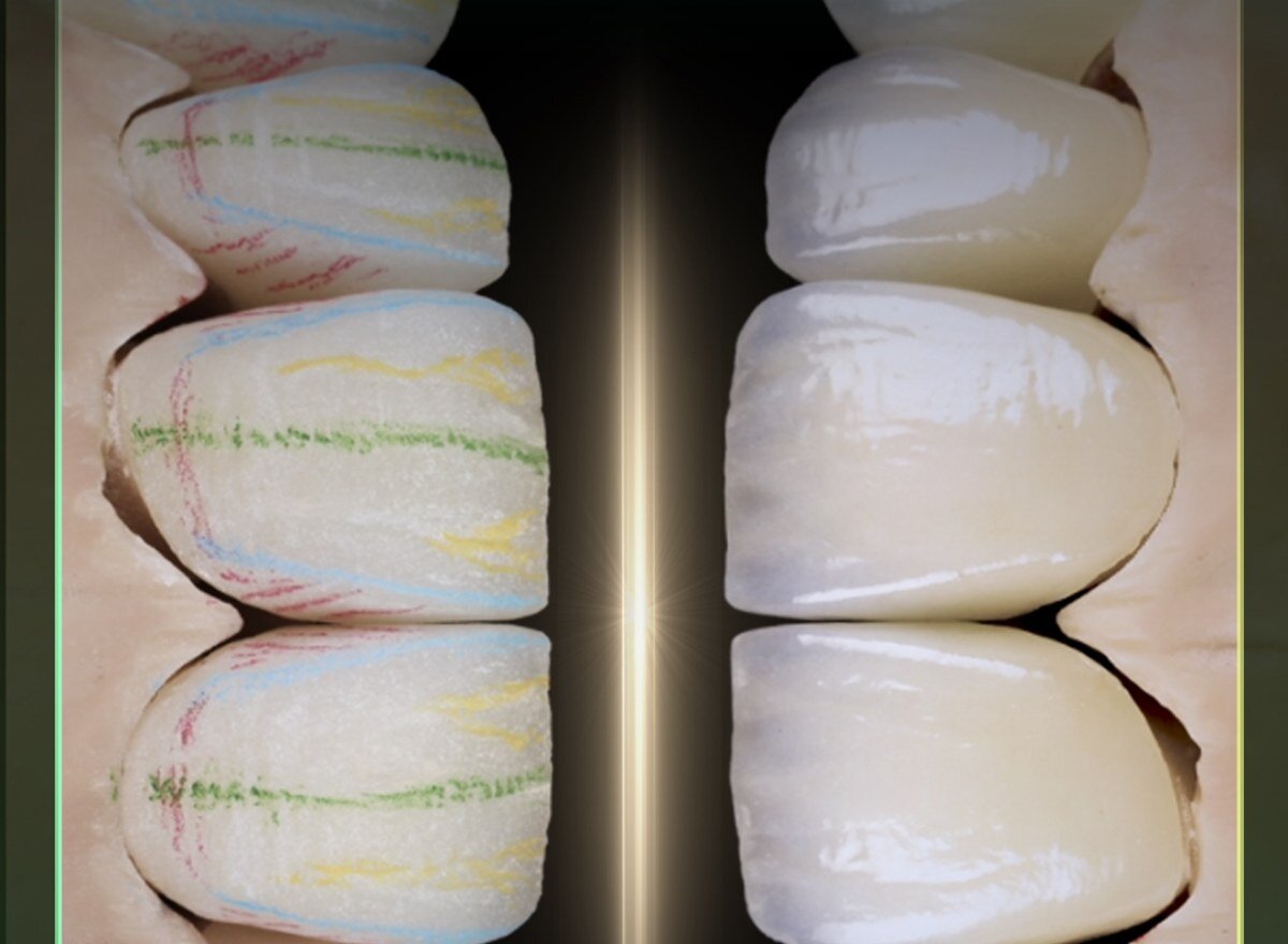 Phục hình zirconia đắp sứ tại Khai Nguyên Dental Lab: bản đồ màu bên trong ở bên trái, phục hình hoàn thiện ở bên phải